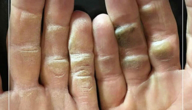 Pro Golfer’s Callused Hands Are Absolutely Disgusting